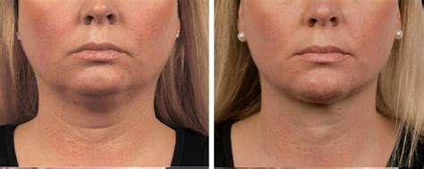 Coolsculpting for double chins .